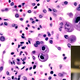 Illustration for article titled Pneumonia Virus Terrified After Remembering What Clintons Capable Of